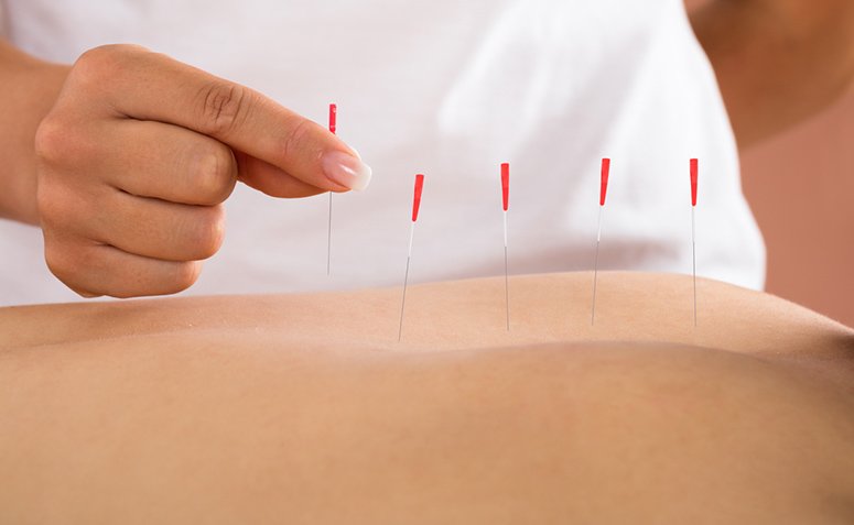 Secretaria de Saúde disponibilizará tratamento de acupuntura na saúde pública